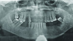 Panoramic radiograph demonstrated severe bone loss.