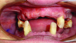 Frontal view following extractions and grafting.