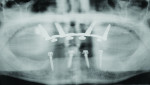X-ray showing final position of implants.