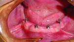A mandibular unibase was made with o-ring housings to snap over the small-diameter
implants.