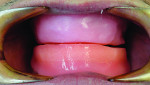 A maxillary/mandibular relationship was taken utilizing baseplates and wax rims.
