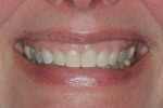 Pretreatment smile showing excessive gingival display.