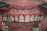 Gingivectomies exposed the enamel of anatomic crowns.