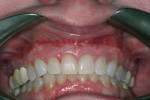 After 8 weeks, the mucosal surgical site had healed well.