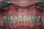 After 12 weeks, the gingival architecture and tooth proportions were more attractive.