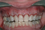 Gingival flaps were secured in position using a continuous 4.0 chromic gut suture.