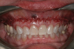 The wound margins were approximated and secured using VICRYL 4.0 sutures.