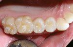 Figure 1  Preoperative occlusal view.