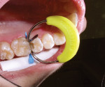 Figure 7  On insertion, the ring separated theteeth and held the matrix against the facial andlingual surfaces of the tooth.