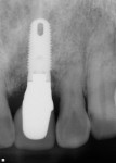 Radiograph and photograph after final crown insertion verifying preservation of bone and soft tissue support.
