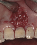 If the gap between the implant and buccal plate is greater than 2 mm, bone grafting is recommended.