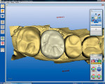 Figure 9  The CEREC AC System automaticallyproposed a full-crown restoration design fortooth No. 14.