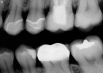 Figure 14  Postoperative radiograph showed excellentmarginal adaptation of the all-ceramic CAD/CAM restorations on teeth Nos. 12 through 15.