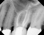Figure 2  Posttreatment radiograph of molar case.
