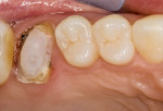 Figure 1  The tooth after core buildup andbefore preparation.