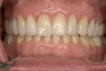 Postoperative view showing the esthetics of the ceramics and the health of the dentogingival complex.