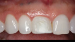 Fig. 3 The finished screw-retained provisional restoration.