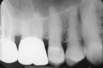 Case 2 preoperative radiograph of tooth No. 3.