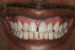 The patient’s high lip line easily displayed a discolored, ill-fitting crown margin affecting the soft tissue.