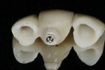The updated screw-retained provisional allowed soft tissue architecture to mature.
