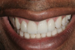 A natural and pleasing smile made the patient more confident.