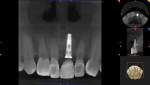 Post-surgical CBCT confirmed ideal placement of the implant.