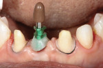 Preserving the periodontal interface on the
impression coping is critical. The compule cap made the screw easily retrievable after the impression has hardened.