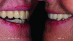 Fig 15 and Fig 16. A natural smile is restored, and natural-looking surface texture returns to the patient's smile.