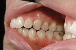 Figure 6  Maxillary right buccal view. Note thecomposite on the mesial of tooth No. 5.