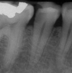 Determining a diagnosis with a
radiograph only can lead the clinician
to treat tooth No. 29 because of the
distal decay. However, if the proper diagnostic
tests are performed on tooth
No. 29, it should reveal the pulp tested
necrotic and its tooth No. 30 that has
a symptomatic irreversible pulpitis.