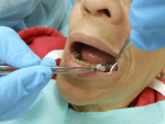 Pulp testing tooth with cold (Endo Ice®, Patterson Dental, www.pattersondental.
com) prior to and after local anesthesia.