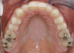 Fig 4. Maxillary occlusal view; note the wear pattern on the lingual surfaces of the incisors.