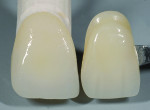Fig 6. No incisal stain is needed on this unit.