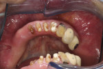 Preoperative view illustrating the non-restorable condition of the lower dentition.
