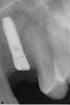 Example of the implant matching the mesio-distal anatomy in the anterior region. The preservation of bone with the OsseoSpeed Profile EV implant prevents the need for osseous recontouring and increases the conditions for a more cosmetic outcome.