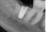 Radiograph showing position of an implant to replace a lower molar. The Profile EV implant is placed to match the mesial ramp of the crestal bone. The result will be preservation of the bone distal to the adjacent premolar and a healthier interproximal architecture.