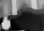The molar implant demonstrates the ability for the Profile EV implant to match the commonly uneven changes to the bone anatomy. The benefits include bone preservation, thereby
eliminating the need for the surgeon to reshape the bone to match the implant.