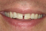 Figure 1  Patient’s smile appearance exhibiting a dental midline diastema of 1.79 mm to 2 mm.