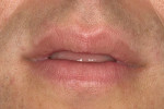 Figure 2  Patient’s oral presentation when lips were in repose.