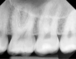 Fig 7. A 3-year follow-up radiograph showed the tooth being asymptomatic.