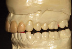 Figure 6  The diagnostic wax-up showing possible dimensions of the proposed incisor restorations and their interplay with the mandibular teeth when the mandible is in lateral excursive movements.