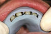 4. A post-polish view of the distal occlusal bulk-filled composite (Beautifil-Bulk Restorative, Shofu) on tooth No. 19. Note the luster as a result of nanofilled composite technology and the chameleon effect that blends the restoration with the tooth surface.