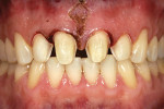 Figure 11  Preparations finalized after periodontal gingivoplasty and frenectomy.