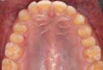Fig 3. Pre-treatment occlusal view depicting loss of enamel and dentin.