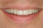 Figure 13  Patient displays natural smile for visualization of prototypes and satisfaction of smile design principles.