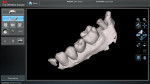 Completed digital scan of implant site fully rendered showing scan body in place with flat spot on the buccal.