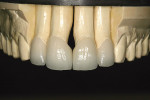 Figure 15  The leucite-reinforced porcelain restorations. Note the extensive over-contour necessary to eliminate a 2-mm midline diastema.
