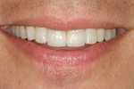 Figure 18  The patient’s natural smile with leucite-reinforced porcelain veneer restoration on teeth Nos. 7 through 10.