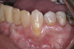 Pretreatment view of tooth No. 22 facial gingival recession defect with noncarious cervical lesion.