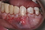 A gingival flap was secured secured over the ADMs and root surfaces with continuous suture.
